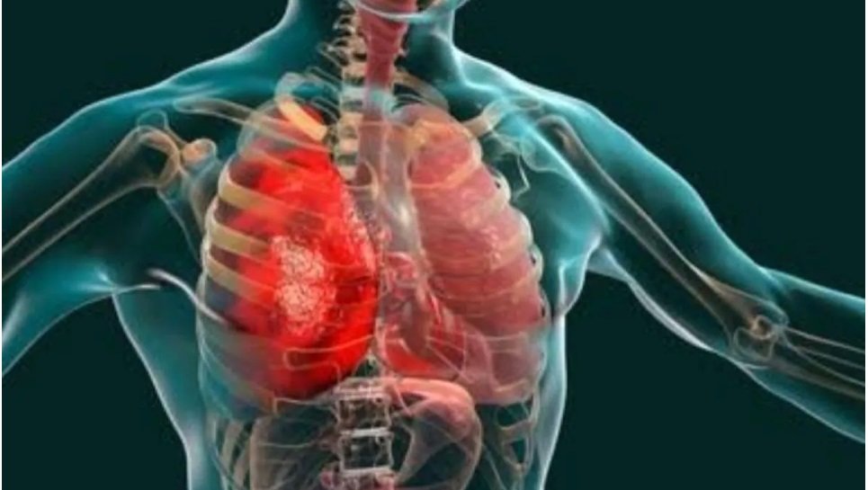 Ilustrasi - Pneumonia. sama seperti saat waktu pandemi COVID-19, pneumonia bisa menyerang pada orang-orang yang sedang tidak fit karena kurang istirahat atau kelelahan. Foto: ANTARA