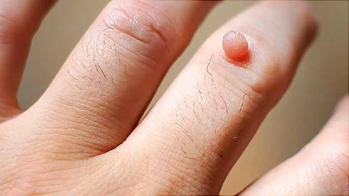 Bukan Hanya Perempuan, Lelaki Juga Berisiko Terinfeksi HPV